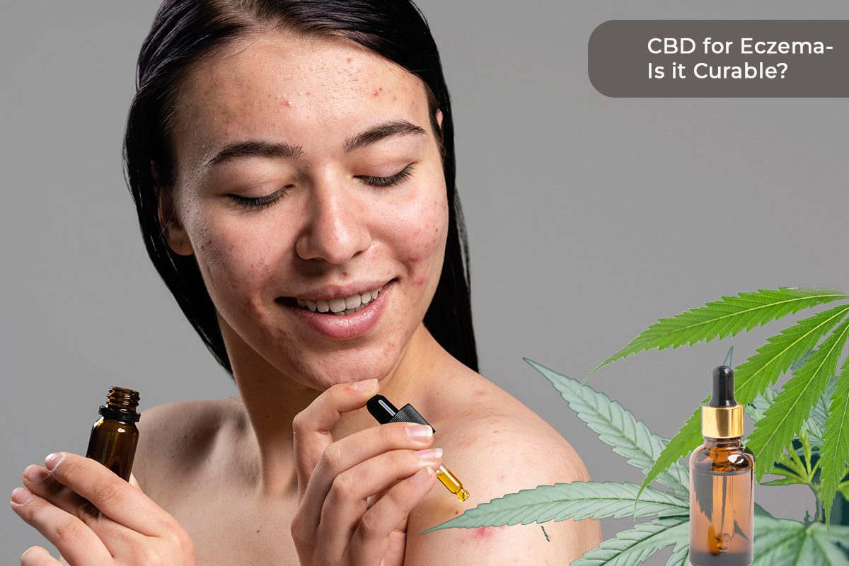 Can CBD Treat Eczema