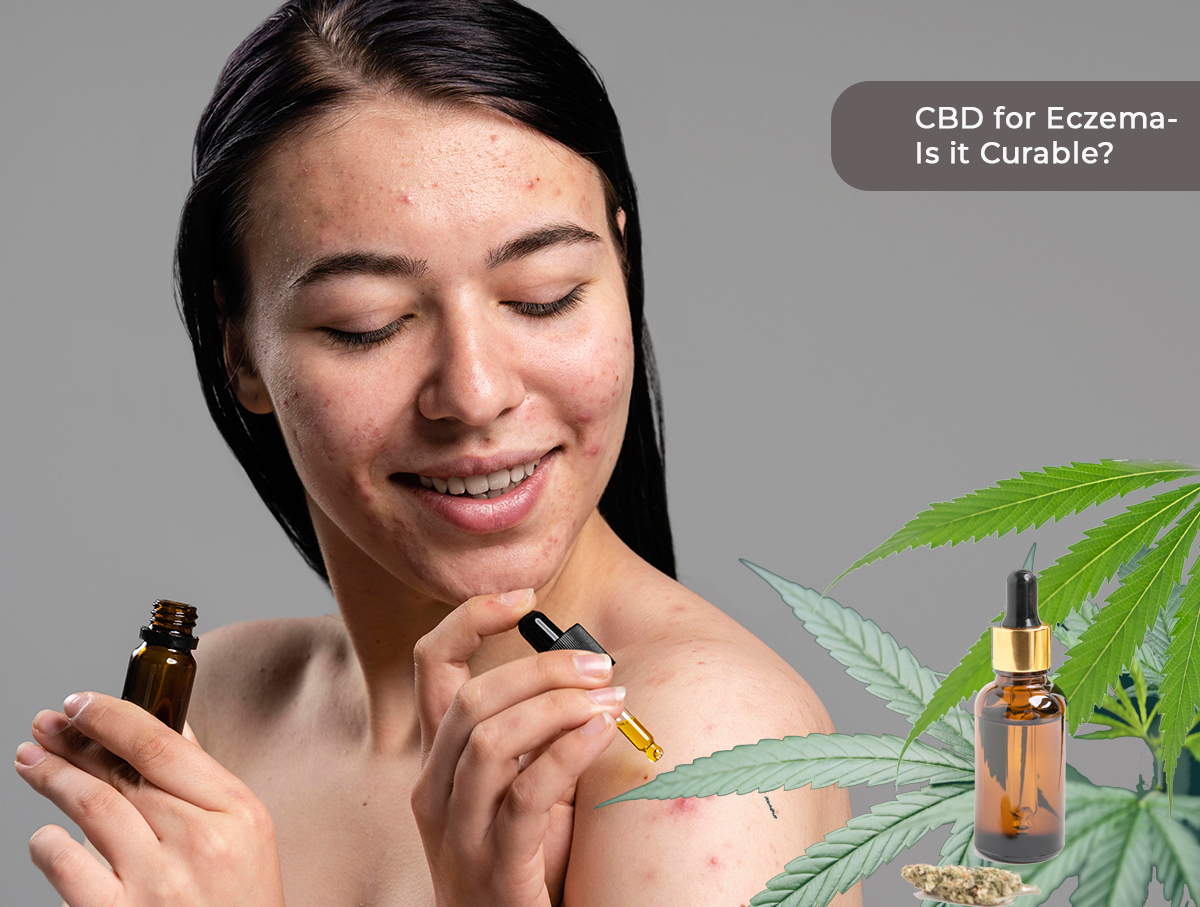 Can CBD Treat Eczema