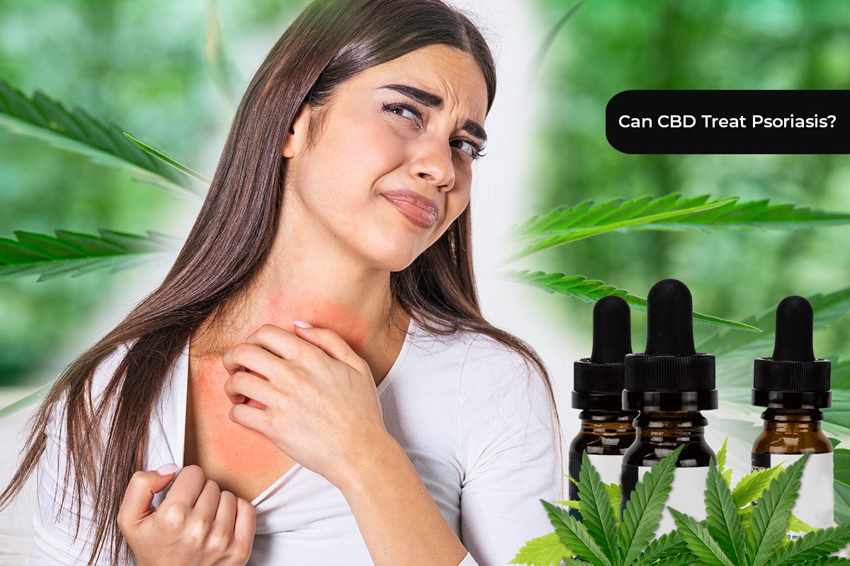 CBD Treat Psoriasis