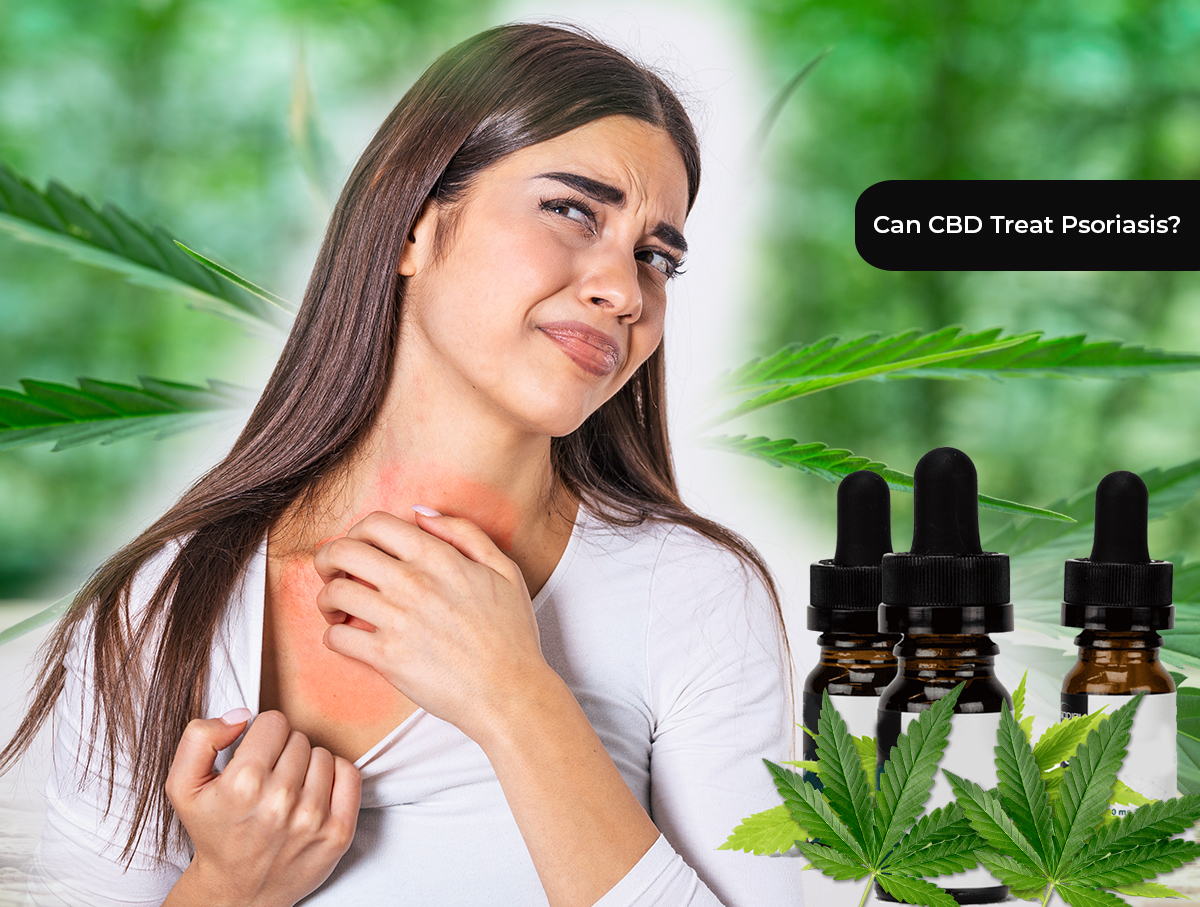 CBD Treat Psoriasis